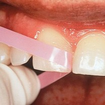 555-L526 Polystrips Green/Red-Fine/Superfine