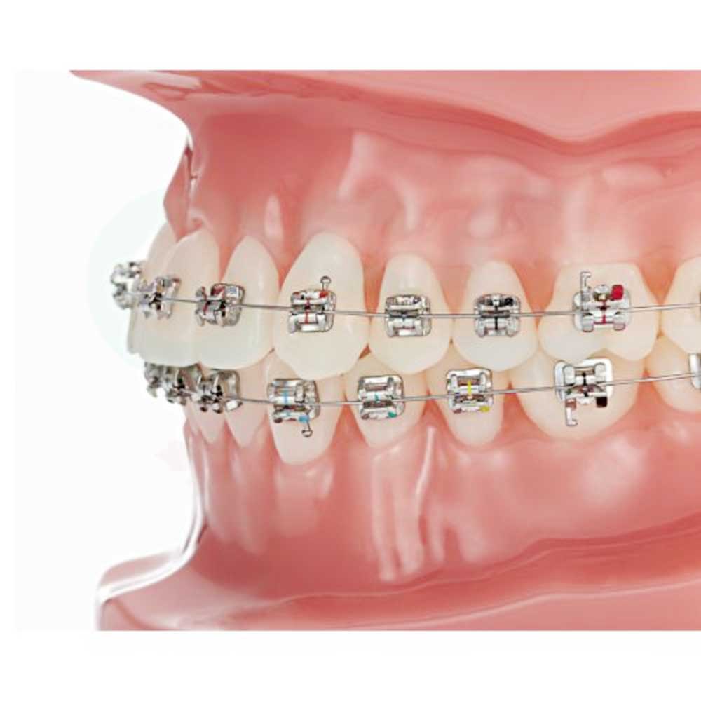 BioQuick Brackets Typodont