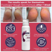 Footlogix Rough Skin Formula (7+) Mousse  4.23 oz.  21131