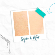 ByeBye Blemish Skin Rescue Serum 30 ml/1 fl oz 16405