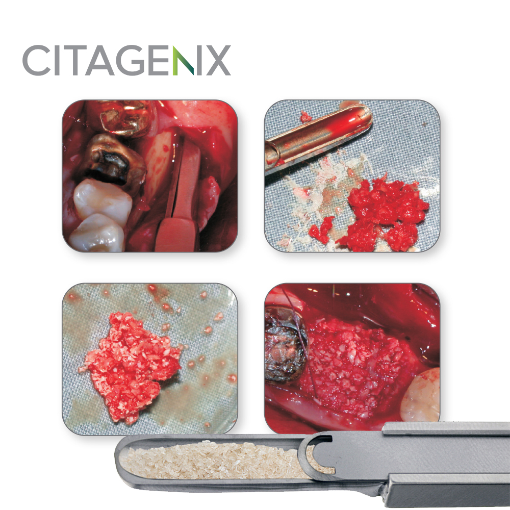 Citagenix Bone Scrapers